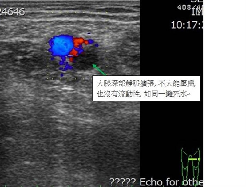 老翁經超音波檢查,發現大腿深部靜脈擴張,不太能壓扁也沒有流動性,如同一攤死水。轉介心臟內科進行靜脈脈動容積記錄檢查後,證實為下肢深部靜脈血栓,經藥物治療後已改善。(彰化醫院提供/吳建輝彰化傳真)